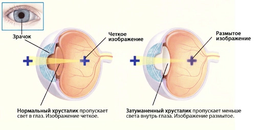 катаракта наглядно