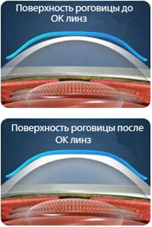 Принцип действия ортокератологических линз