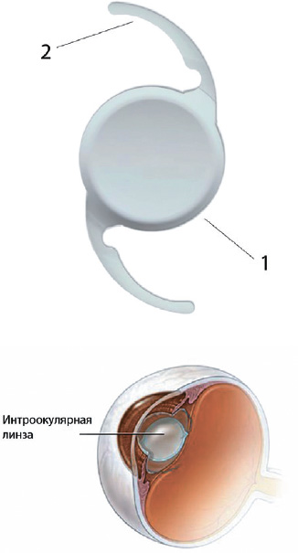 строение искусственного хрусталика