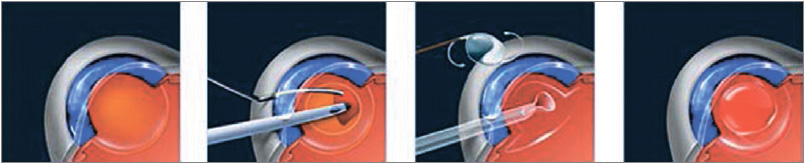 процесс имплантации искусственного хрусталика