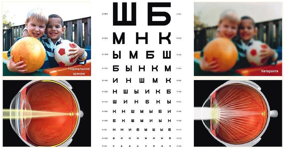 Что такое катаракта